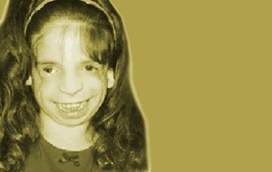 Treacher-Collins Syndrome (TCS)
