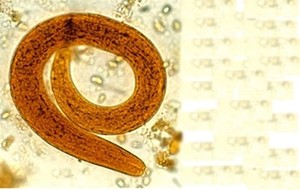 Strongyloidiasis