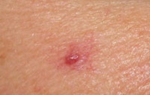 Spider Angioma