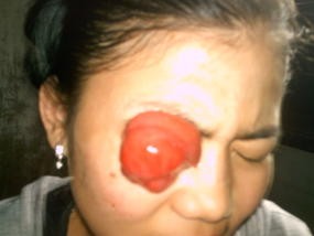 9 Tahun Magfiroh Derita Tumor Ganas di Mata