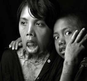 Kisah Santi yang Dibakar Suaminya