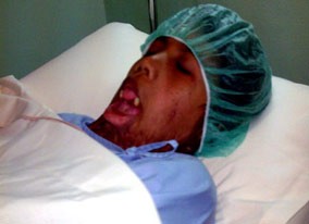 Perban di Tubuh Santi Segera Dibuka