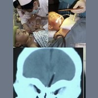 Hidung Bocah Kemasukan Sumpit yang Tembus Hingga Otak Depan