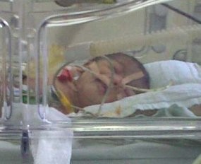 RS Kariadi Operasi Bayi Tanpa Dinding Perut