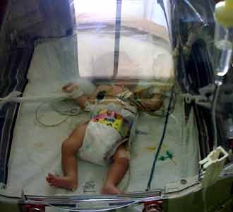 Bayi Tanpa Dinding Perut Dioperasi