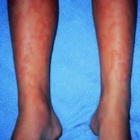 Alergi obat pada kulit