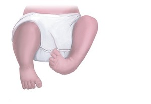 Mencegah Anak Berkaki O dan X