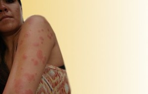 Erythema Multiforme