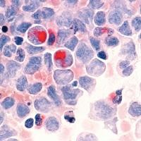 Titik Cerah Melawan Leukemia