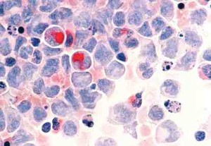 Titik Cerah Melawan Leukemia