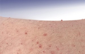 Petechiae