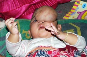 Wajah Ayu, Bayi 6 Bulan Muncul Benjolan Daging