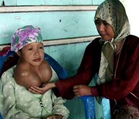Derita Misbahanah dengan Tumor Leher Seberat 3 Kg