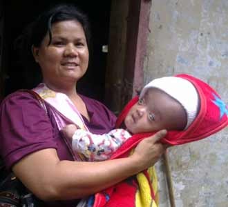 Aura, Bayi Hydrochepalus Diterima RSCM