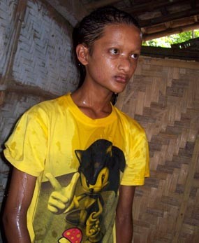 Bocah di Probolinggo Idap Penyakit Langka