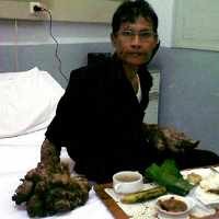 Kebiasaan Merokok Berpotensi Menambah Komplikasi Penyakit Dede