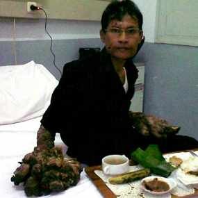 Operasi Dede Dijadwalkan Minggu Depan