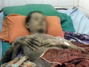 Agus Manusia Ikan Jalani Terapi Khusus