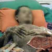 Agus Manusia Ikan Jalani Terapi Khusus