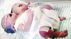 Bayi Berkepala Dua Hanya Bertahan 24 Jam