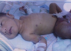 Rizki, Bayi 19 Hari Kena Tumor Langka 