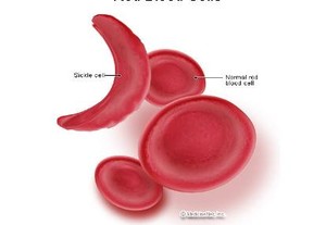 Sel Darah Merah Berbentuk Bulan Sabit yang Bikin Sengsara