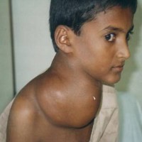 Waspadai Penyakit Hodgkins Pada Anak-anak