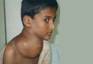 Waspadai Penyakit Hodgkins Pada Anak-anak