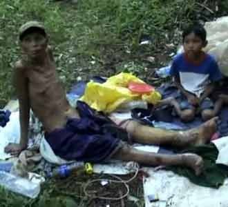 Suryadi Diasingkan Akibat Kusta