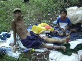 Anak Angkat Suryadi Positif Tertular Kusta