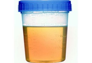 Jangan Anggap Remeh Darah di Urine