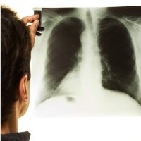 Pengendalian TB di Indonesia Mendekati Target MDG