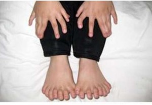 Bocah Punya 31 Jari Tangan dan Kaki