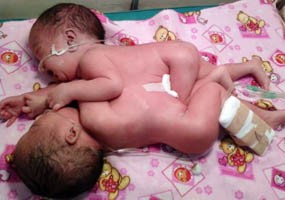 Kembar Siam Kediri Meninggal Dunia