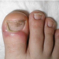 Cantengan Paling Doyan Kuku Jari yang Lembab