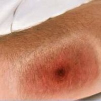 Penyakit Mematikan Antraks Muncul di Maros