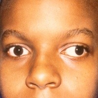 Anak Bermata Juling Berisiko Rabun Jauh