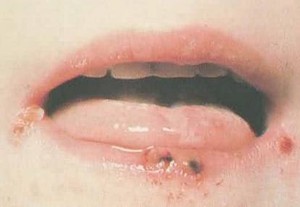 Cara Menghindari Penyakit Herpes