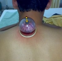 Bugar Kembali dengan Bekam