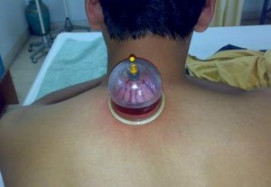 Bugar Kembali dengan Bekam