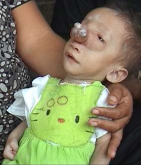 Hidung Balita di Banyuwangi Digerogoti Tumor, Duh...