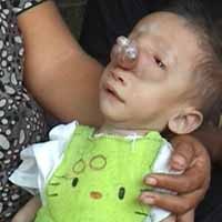 Hidung Balita di Banyuwangi Digerogoti Tumor, Duh...
