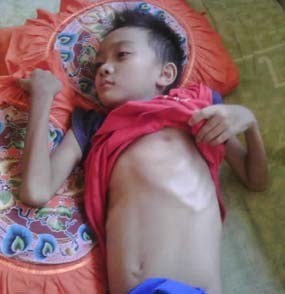Bocah MI Alami Jantung Bocor Sejak Balita