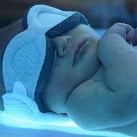 Waspadai Atresia Bilier Pada Bayi Kuning