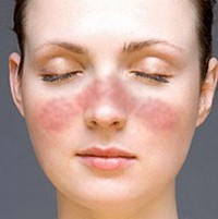 Dokter Sering Tertipu Lupus