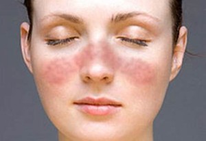 Dokter Sering Tertipu Lupus