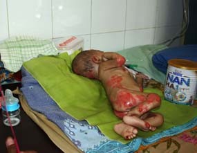 Dua Bayi Alami Gizi Buruk & Kulit Mengelupas 