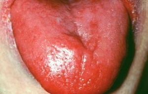 Atrophic pada Lidah