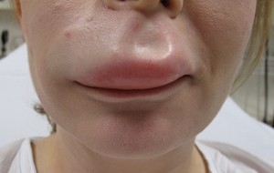 Angiodema