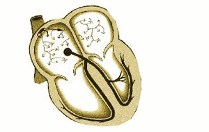 Atrium Myxoma